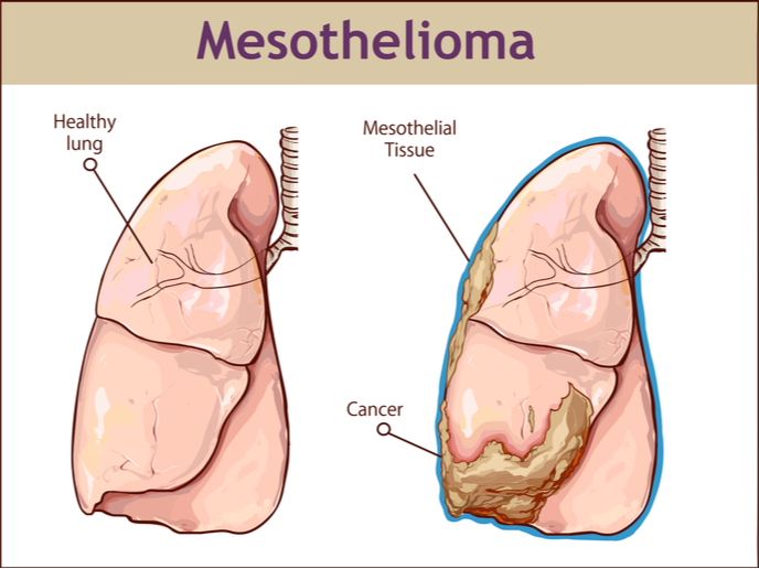 Clinical Trial In Europe Offers Hope For Asbestos Related Cancer Patients News Cordis European Commission