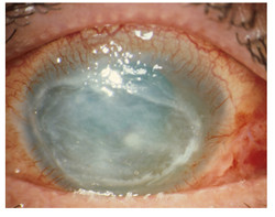 PHMB-Augentropfen zur Behandlung von Akanthamöbenkeratitis | ODAK Project |  Results in brief | FP7 | CORDIS | European Commission