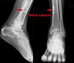 La métastase osseuse induite par le cancer | BONE-NET Project ...