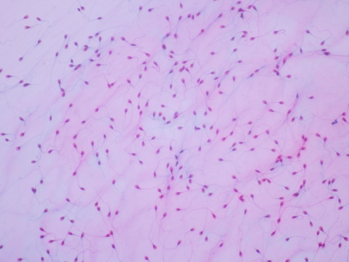 Nuovo test per l'infezione batterica anaerobica negli uomini aiuta a  ridurre l'infertilità | DetectInMen Project | Results in brief | H2020 |  CORDIS | European Commission